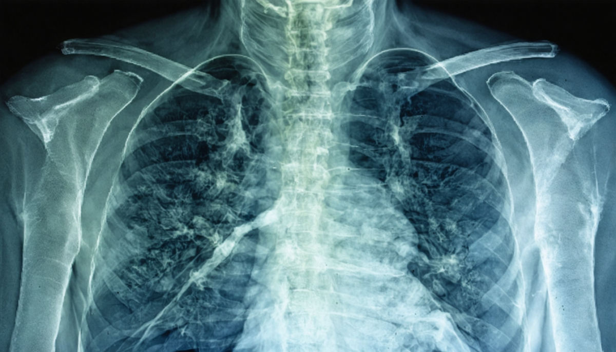 découvrez l'importance de la radio des poumons chez le fumeur et ce que cet examen révèle sur la santé pulmonaire pour un diagnostic précis et préventif.